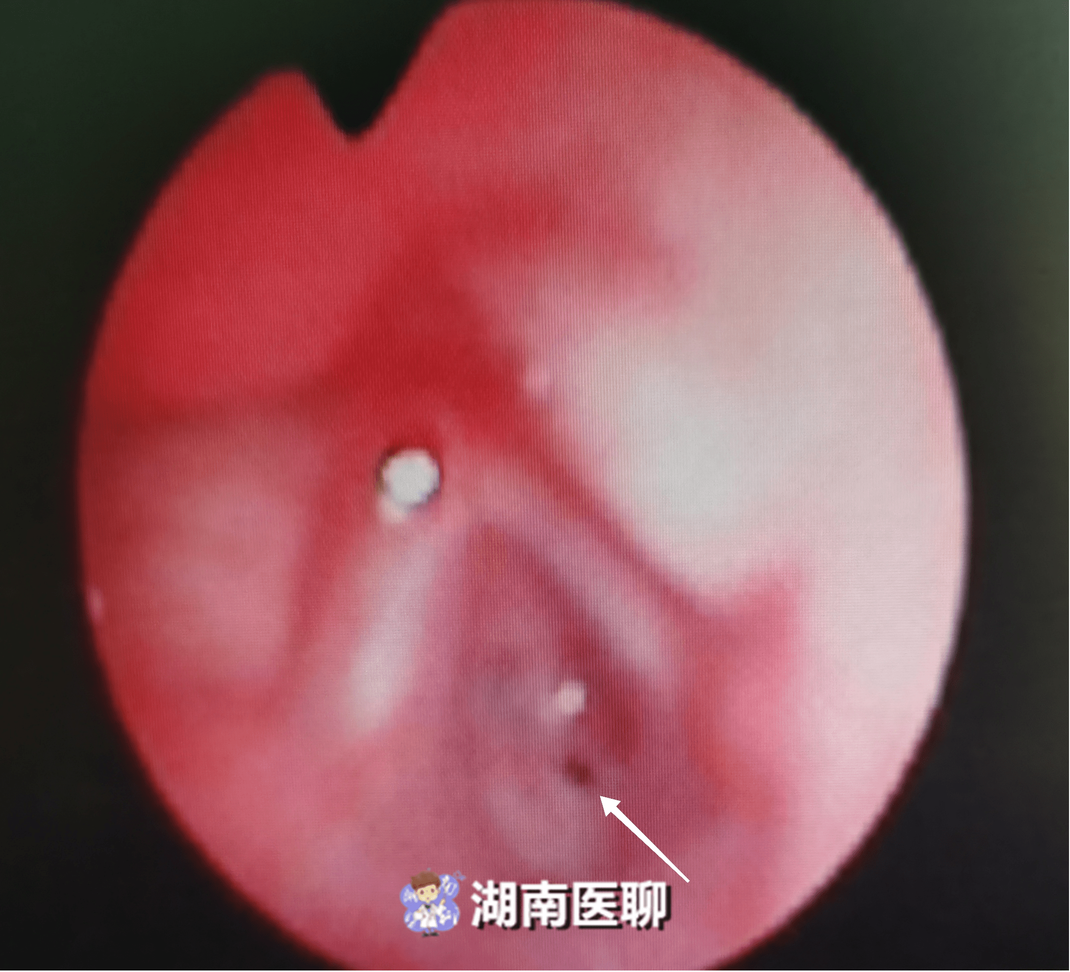 取卵腹水图片，揭示背后的医学现象与挑战