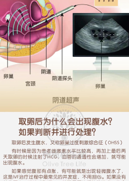 取卵后腹水与不腹水的探讨